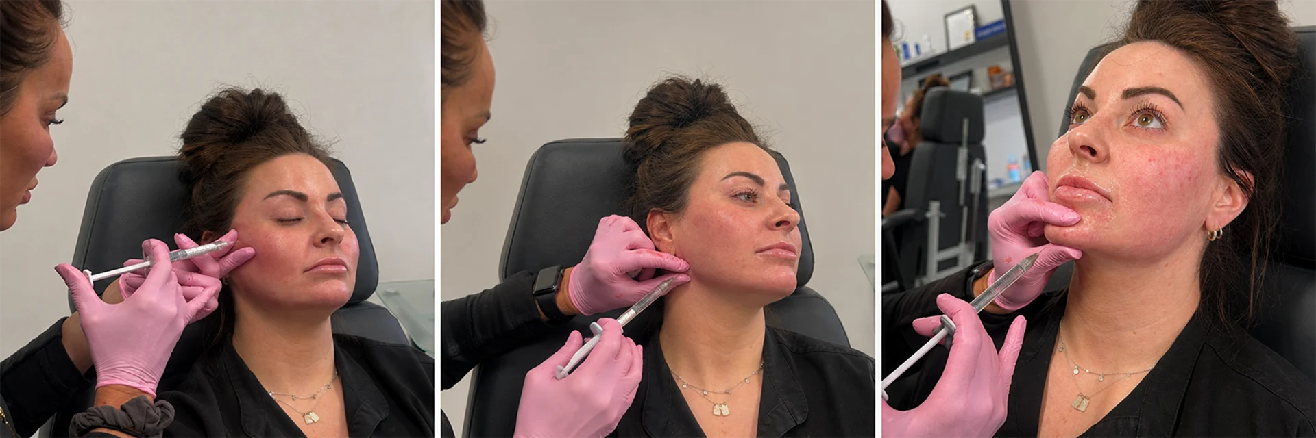 Belotero Balance filler injections at Elle Medical & Aesthetics in Lafayette, LA
