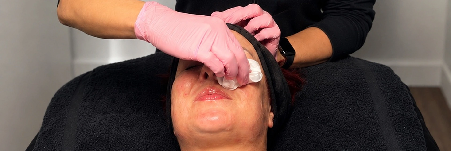 Chemical peel treatment in progress at Elle Medical & Aesthetics in Lafayette
