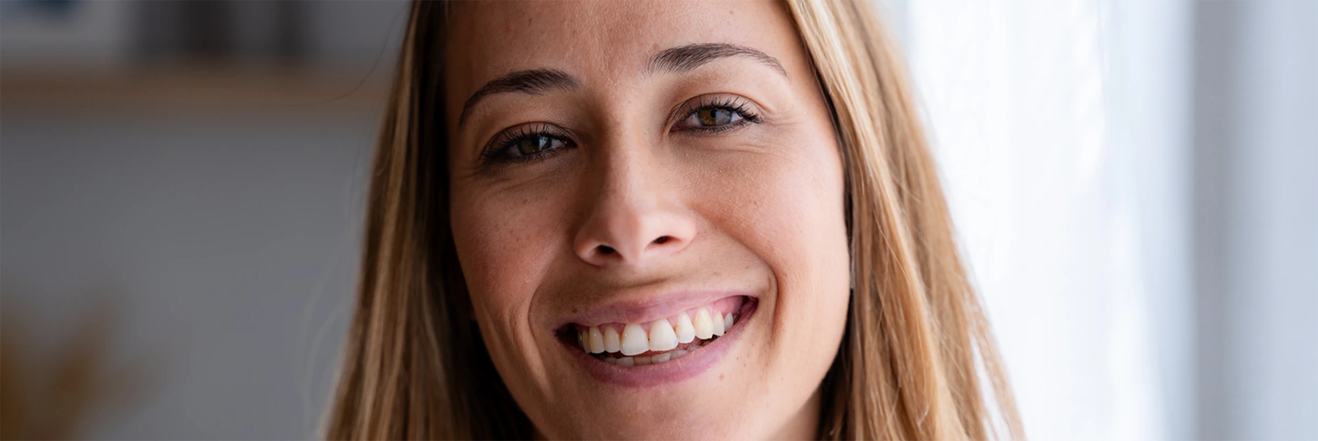 IPL photofacial results at Elle Medical & Aesthetics in Lafayette, LA