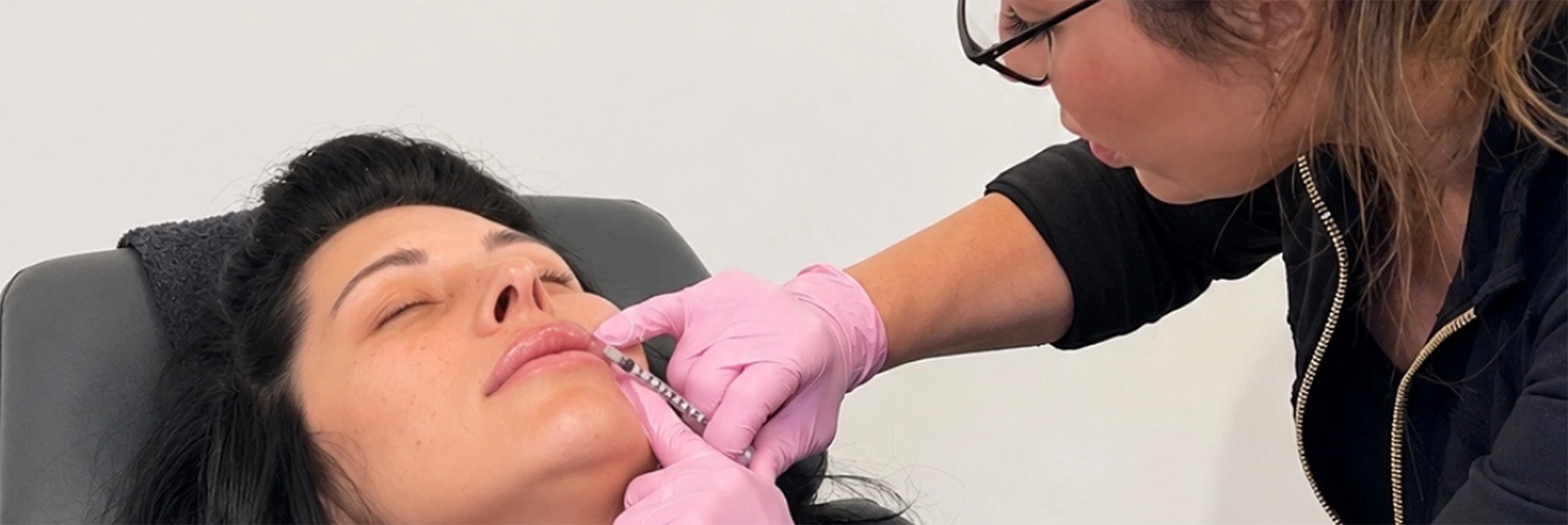 Juvéderm dermal filler treatment in Lafayette, LA