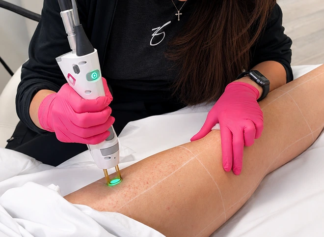 Provider performing laser hair removal on a patient's leg