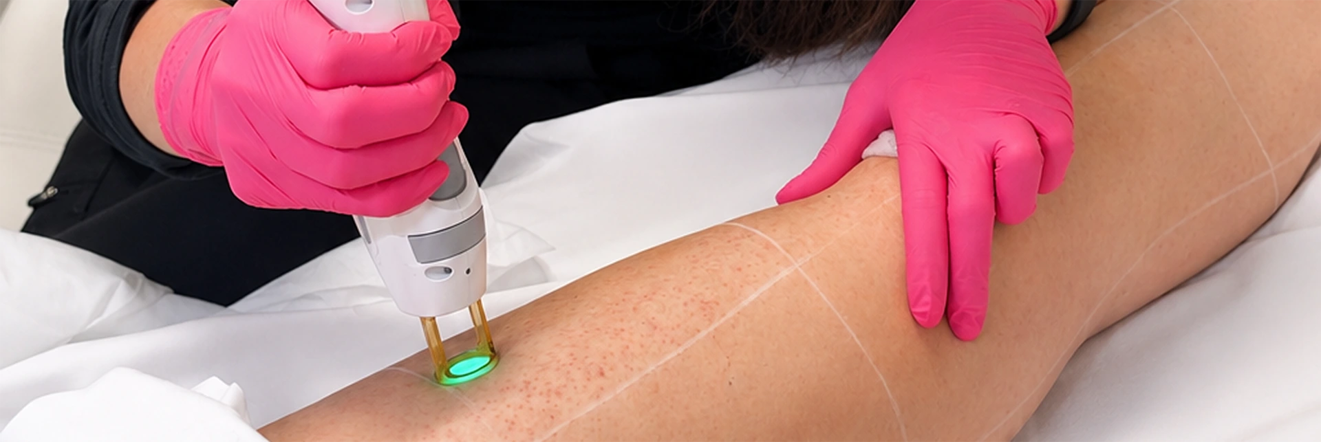 Laser hair removal treatment at Elle Medical & Aesthetics in Lafayette