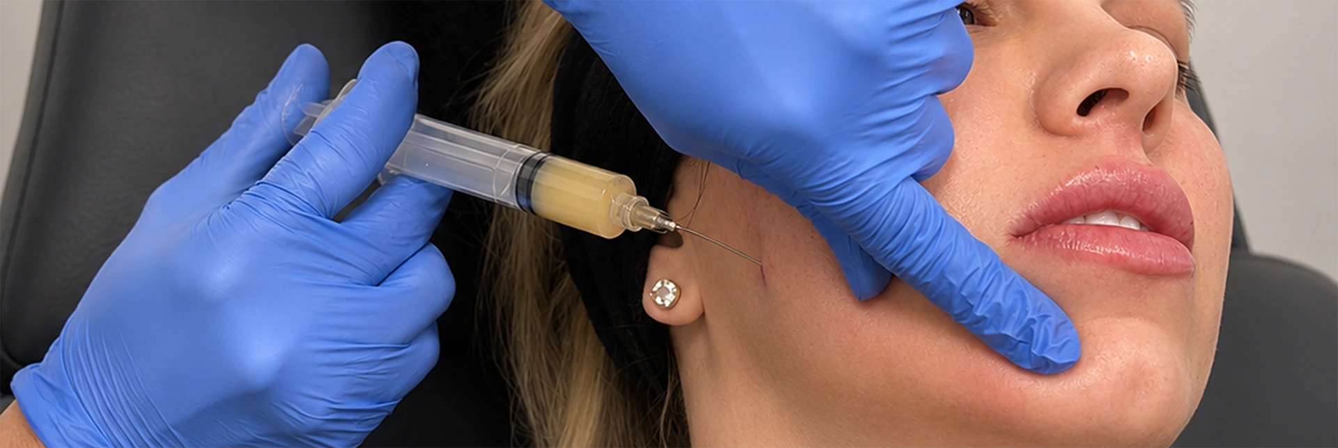 Pure Biofill injection at Elle Medical & Aesthetics in Lafayette, LA